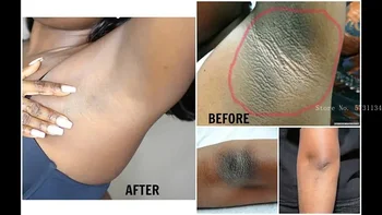 Pielęgnacja skóry Intymne Rozjaśnienie Skóry i Wybielanie Krem - Serum na Przebarwienia